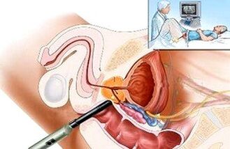 Manieren om prostatitis te diagnosticeren
