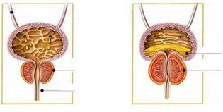 Soorten en vormen van prostatitis bij mannen