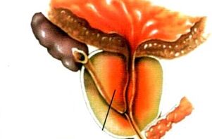 Wat is prostatitis bij mannen