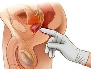 Prostaatmassage voor de behandeling van prostatitis bij mannen