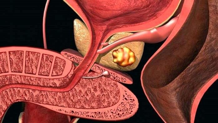 Steenafzettingen in de prostaat met ernstige prostatitis