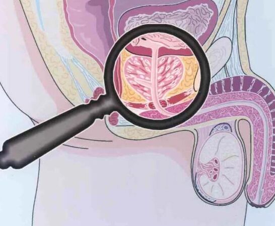 Prostatitis