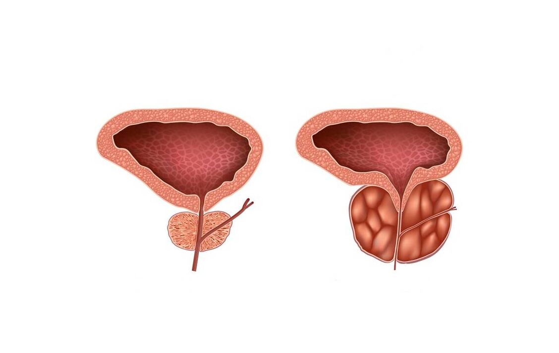 symptomen van prostatitis bij mannen