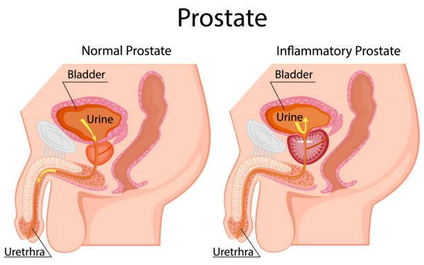 gezonde en ontstoken prostaat