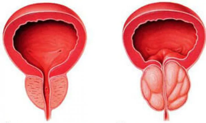 Normale prostaat (links) en ontstoken chronische prostatitis (rechts)