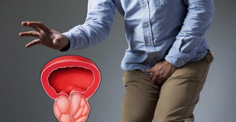 symptomen van prostatitis bij mannen