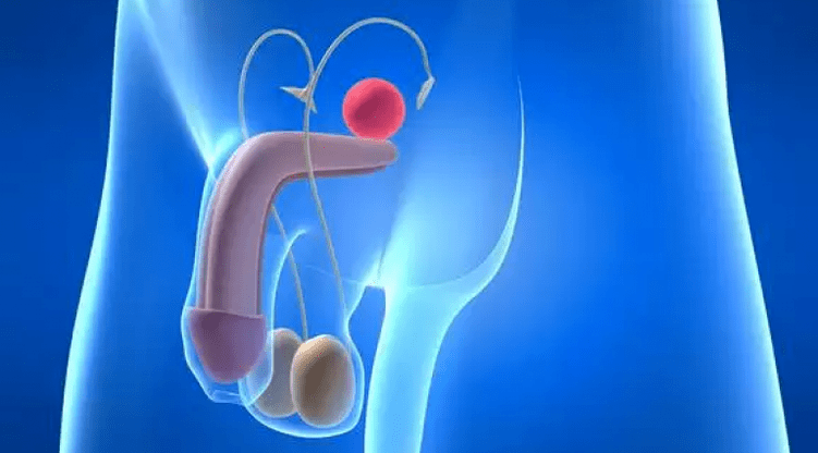 Prostatitis is een ontsteking van de prostaatklier bij mannen, die een complexe behandeling vereist